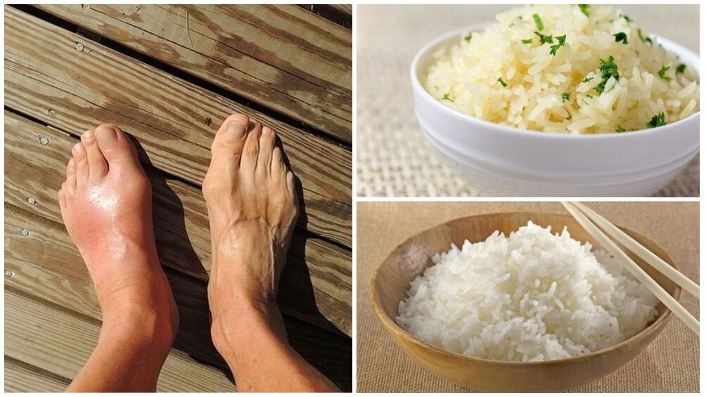 Uma dieta à base de arroz é recomendada para pacientes com gota. 